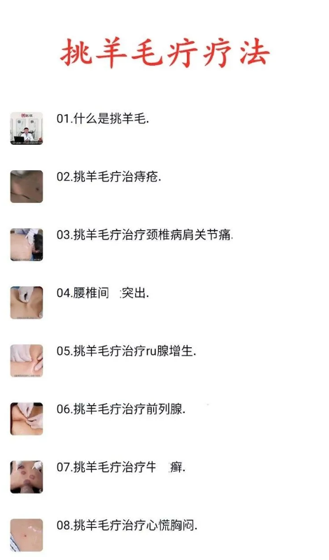 图片[2]-挑羊毛疔疗法针法针刺穴位经络经脉中医视频教程【百度网盘下载】
