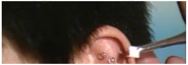 图片[3]-耳针疗法耳穴耳针穴位技术视频教程【百度网盘下载】