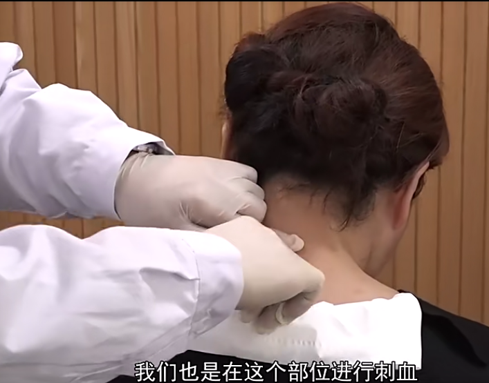 图片[10]-王合民刺络放血挑羊毛疔中风偏瘫膏药中医视频教程合集【百度网盘下载】