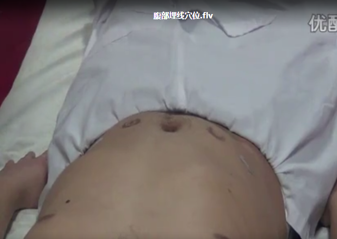 图片[7]-穴位埋线微针埋线高级埋线减肥美容及疼痛埋线视频教程【百度网盘下载】