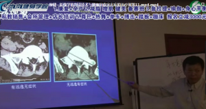 柳健公开课影像学腰椎间盘突出视频教程-百度网盘下载-正骨教程博客