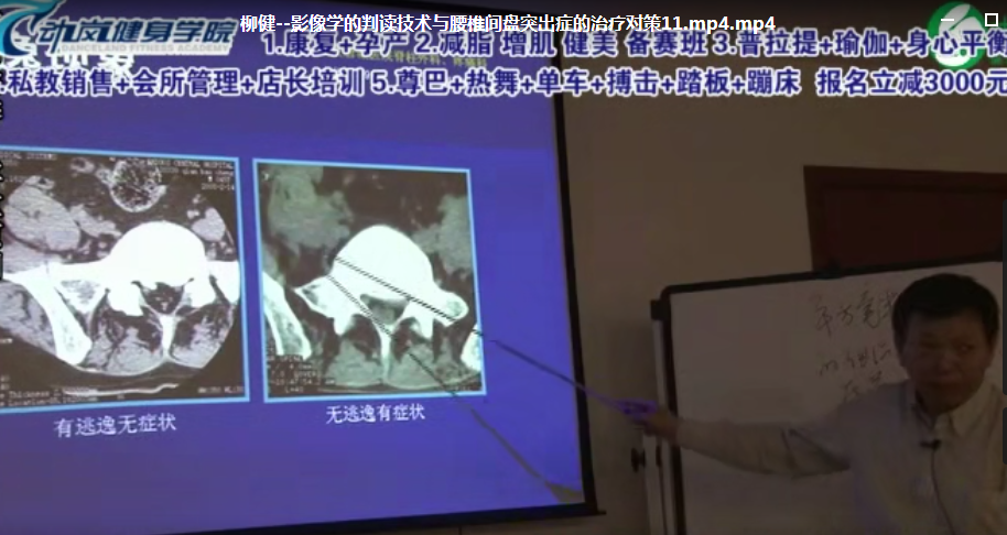 柳健公开课影像学腰椎间盘突出视频教程【百度网盘下载】
